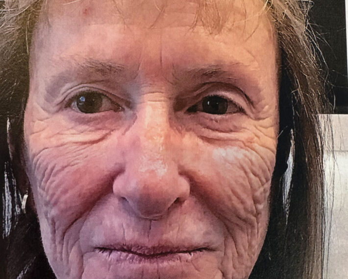 1.-Wrinkles-before-Acelift