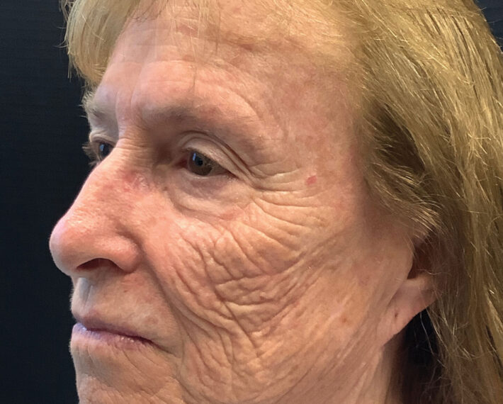 2.-Left-side-wrinkles,-melanoma-visible