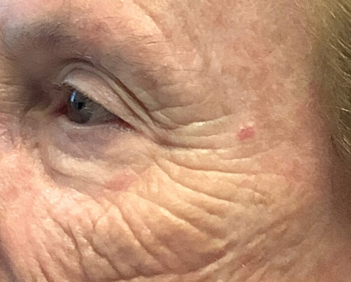 3.-Closeup-of-pink-melanoma-before-biopsy