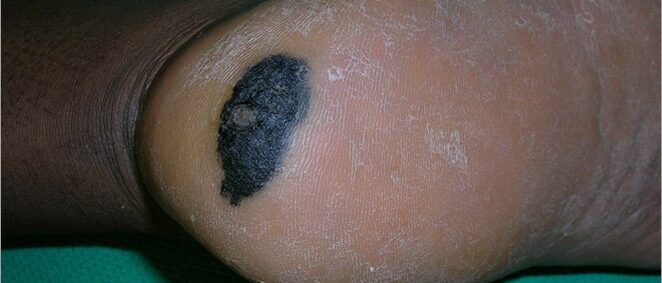 Acral lentiginous melanoma on heel Acral lentiginous melanoma on heel