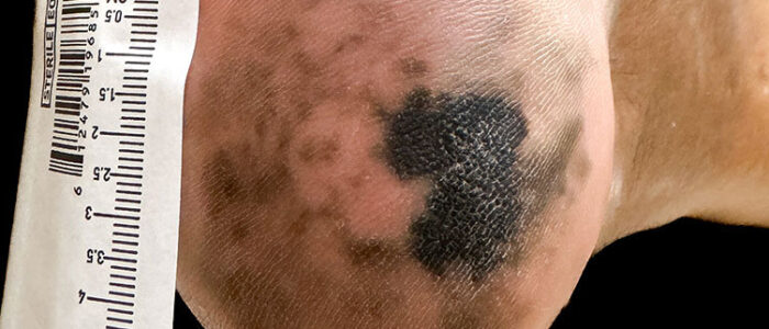 Acral lentiginous melanoma on heel of foot Acral lentiginous melanoma on heel of foot