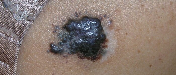 Dark, raised melanoma Dark, raised melanoma
