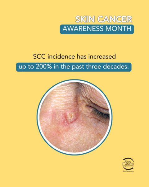 Skin cancer awareness month poster with a photo of skin cancer on the face.