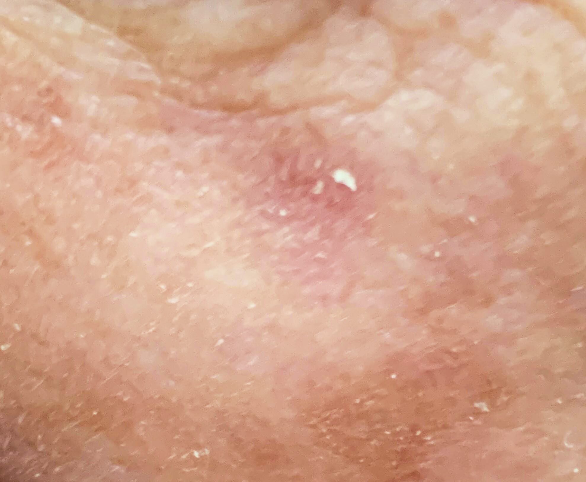 Actinic keratosis on head or neck