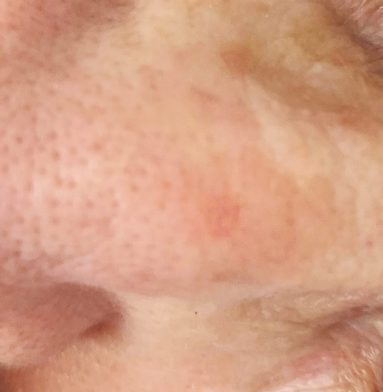 Actinic keratosis on head or neck