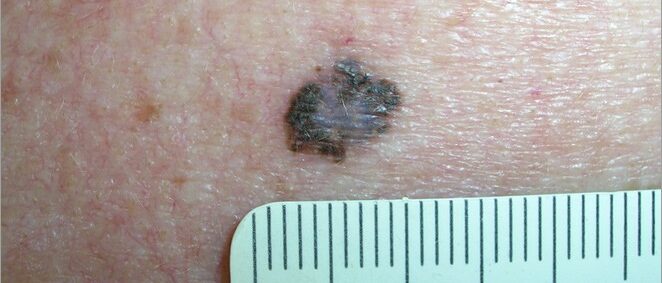 Large melanoma with irregular borders Large melanoma with irregular borders