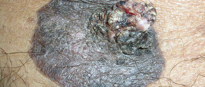 Large pigmented squamous cell carcinoma