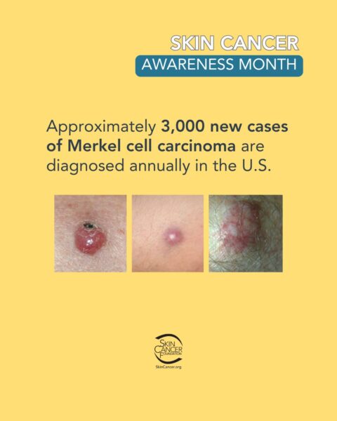 A Skin Cancer Awareness Month poster with information and example images of Merkel cell carcinoma.