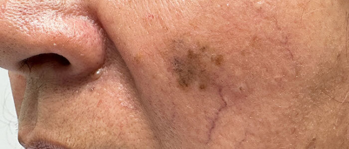 Melanoma on cheek Melanoma on cheek