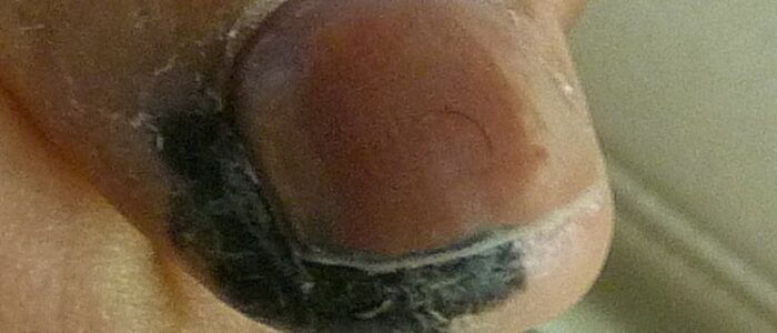 Melanoma on finger Melanoma on finger