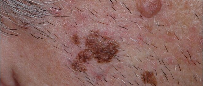 Melanoma with asymmetry and irregular borders Melanoma with asymmetry and irregular borders