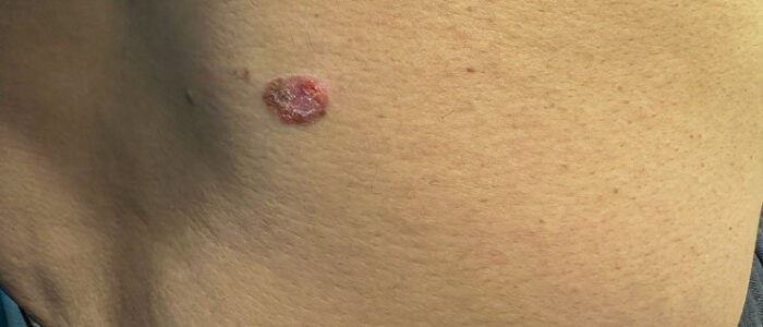 Raised, reddish squamous cell carcinoma