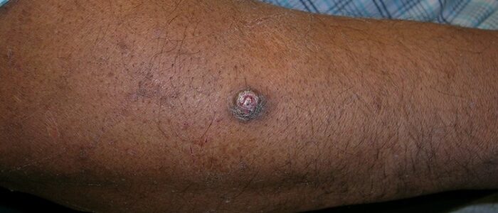 Squamous cell carcinoma on forearm of man with darker skin tone