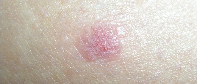 Squamous cell carcinoma on light skin