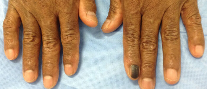 Subungual melanoma on fingernail Subungual melanoma on fingernail