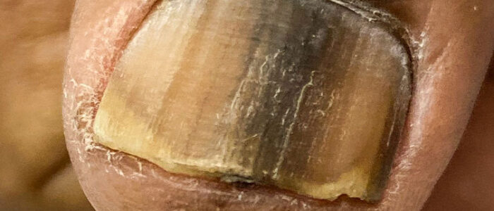 Subungual melanoma under toenail Subungual melanoma under toenail