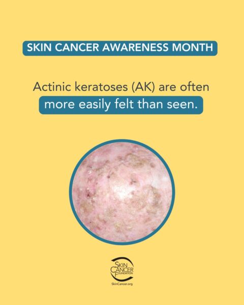 Skin Cancer Awareness Month poster with text "Actinic keratoses (AK) are often more easily felt than seen," image of skin condition inside a blue circle, and Skin Cancer Foundation logo.