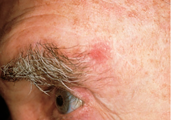 basal cell carcinoma 3 irritated reddish patch on man's forehead basal cell carcinoma