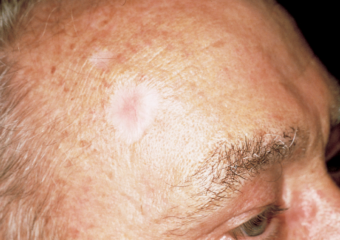 basal cell carcinoma 4 scar picture white scar man forehead basal cell carcinoma