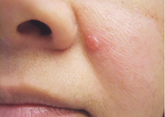 Basal cell carcinoma bcc shiny bump or nodule that is pearly or clear, pink, red or white