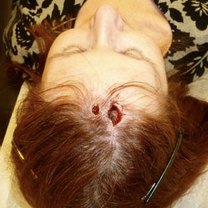 julie-4 skin cancer removal surgery