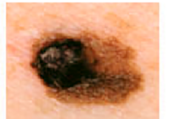 melanoma_1_Asymmetry Picture of mole with asymmetry, melanoma warning sign