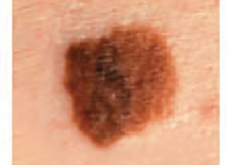 Melanoma_Diameter_SCF picture uncommon large mole