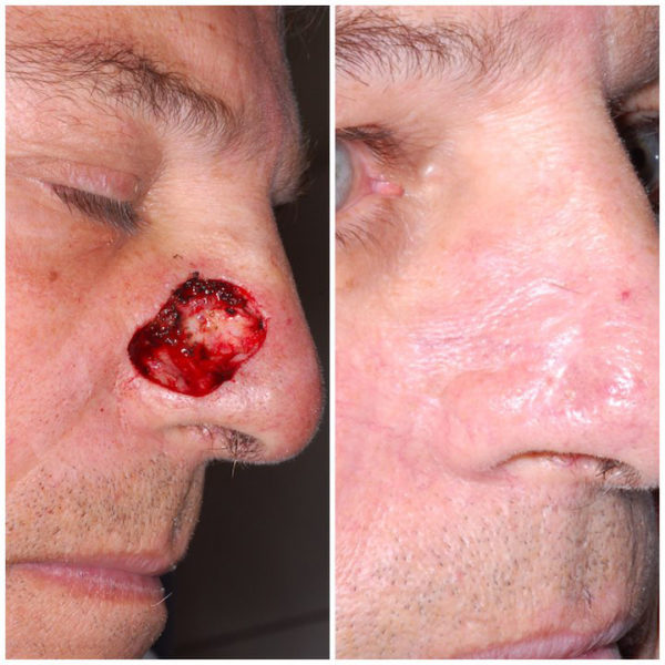 mohs2 post mohs surgery flap