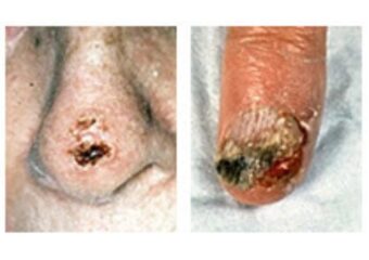 Une plaie ouverte qui saigne, forme des croûtes et persiste depuis plusieurs semaines.